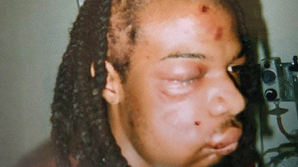 Terez Miles took this photo of her son, Jordan, after he was released from the hospital, following the incident with Pittsburgh police officers.