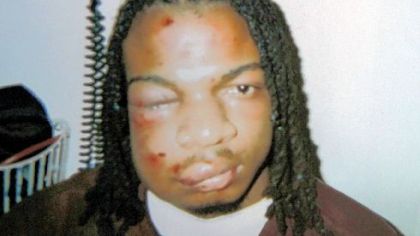 Jordan Miles, swollen and bruised after his arrest in Homewood, in a photo taken by his mother.