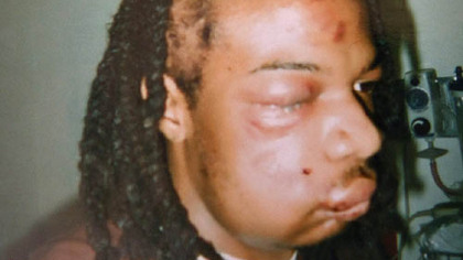 Jordan Miles' badly bruised head and face after being arrested by Pittsburgh police officers.