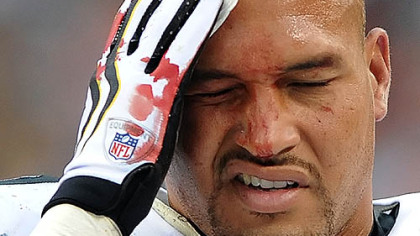 Linebacker James Farrior leaves the game after suffering a deep cut on his head in the first half against the Broncos.
